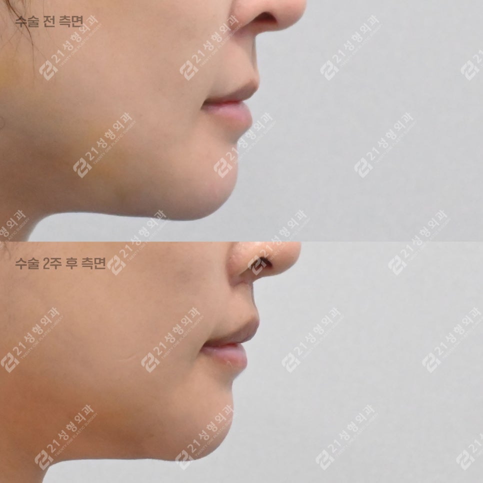 A Lip-Philtrum Reduction Surgery Case: Why Philtrum Dimple Surgery Was Performed Together image 7