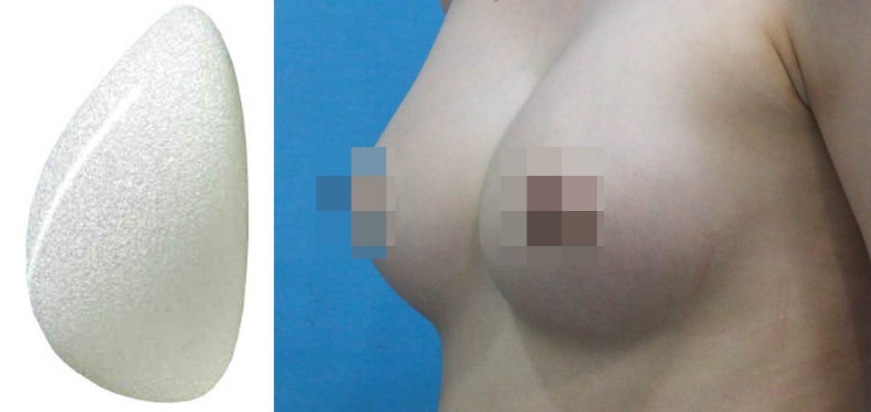 [가슴 수술] 보형물 모양 결정은 어떻게?   물방울? 라운드? 관련 이미지 9