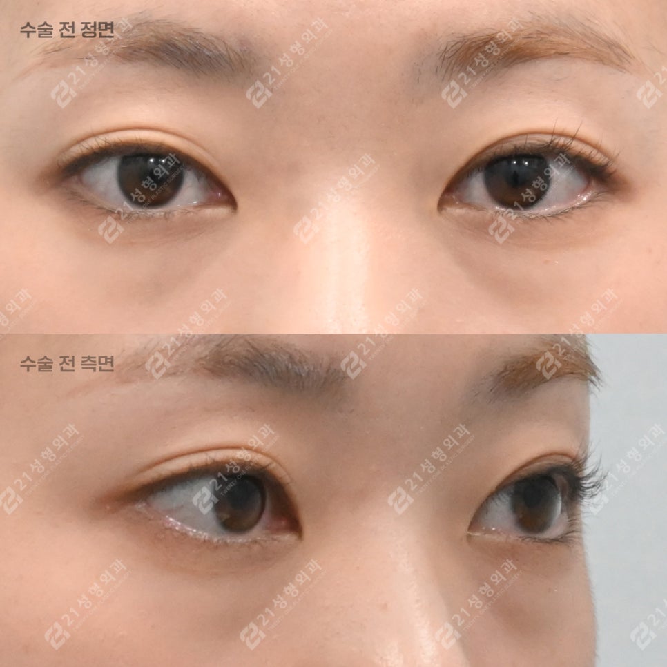 눈밑지방재배치를 받았는데 애교살이 없어졌어요 관련 이미지 3