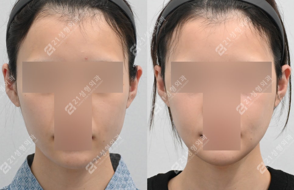 얼굴살이 적으면 윤곽수술 효과가 더 좋을까요? 관련 이미지 1