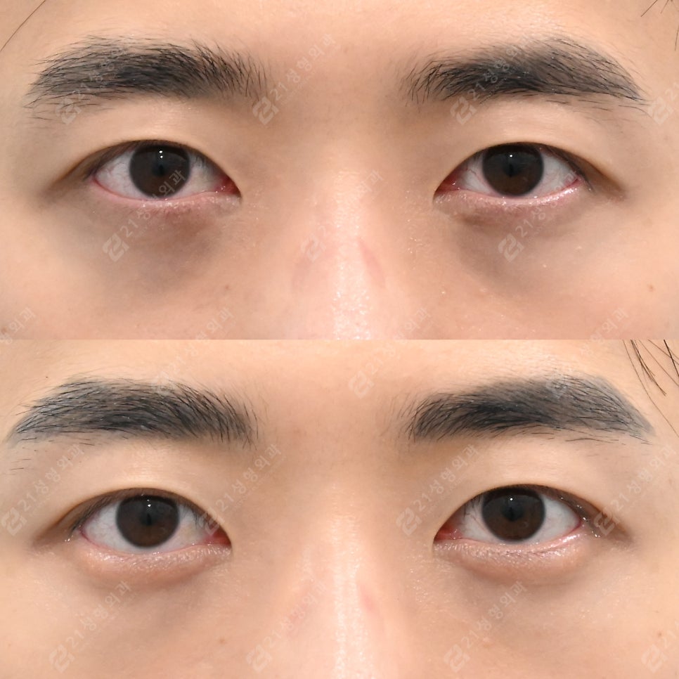 Before-and-After Case of Lower Eyelid Fat Repositioning Surgery for Men image 3