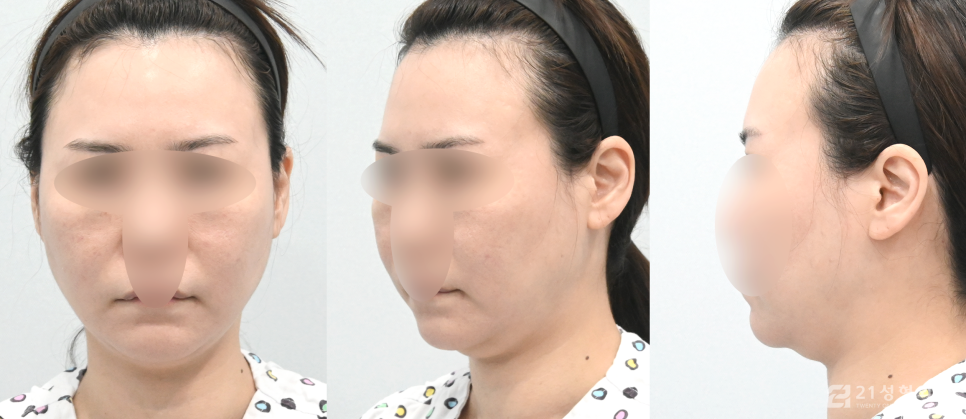 턱밑침샘개선방법으로 이중턱 얼굴라인을 갸름하게 관련 이미지 4