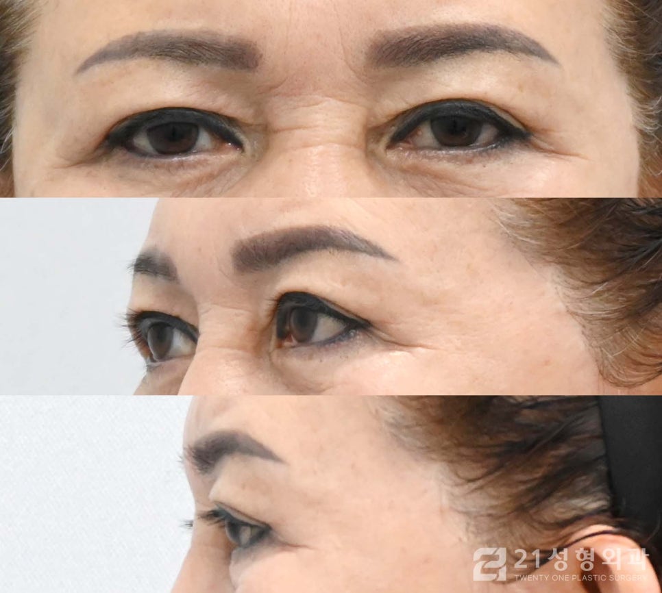 상안검수술흉터 안 보이게 하려면 관련 이미지 5