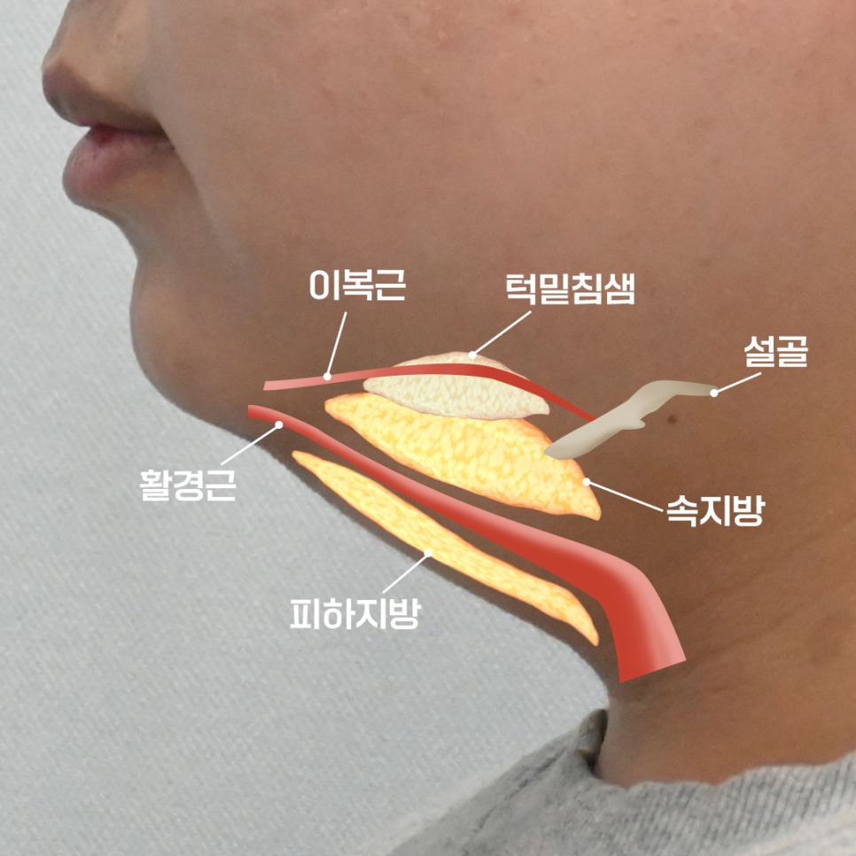 이중턱 수술, 구조 분석이 먼저입니다 (케이스 소개) 관련 이미지 3