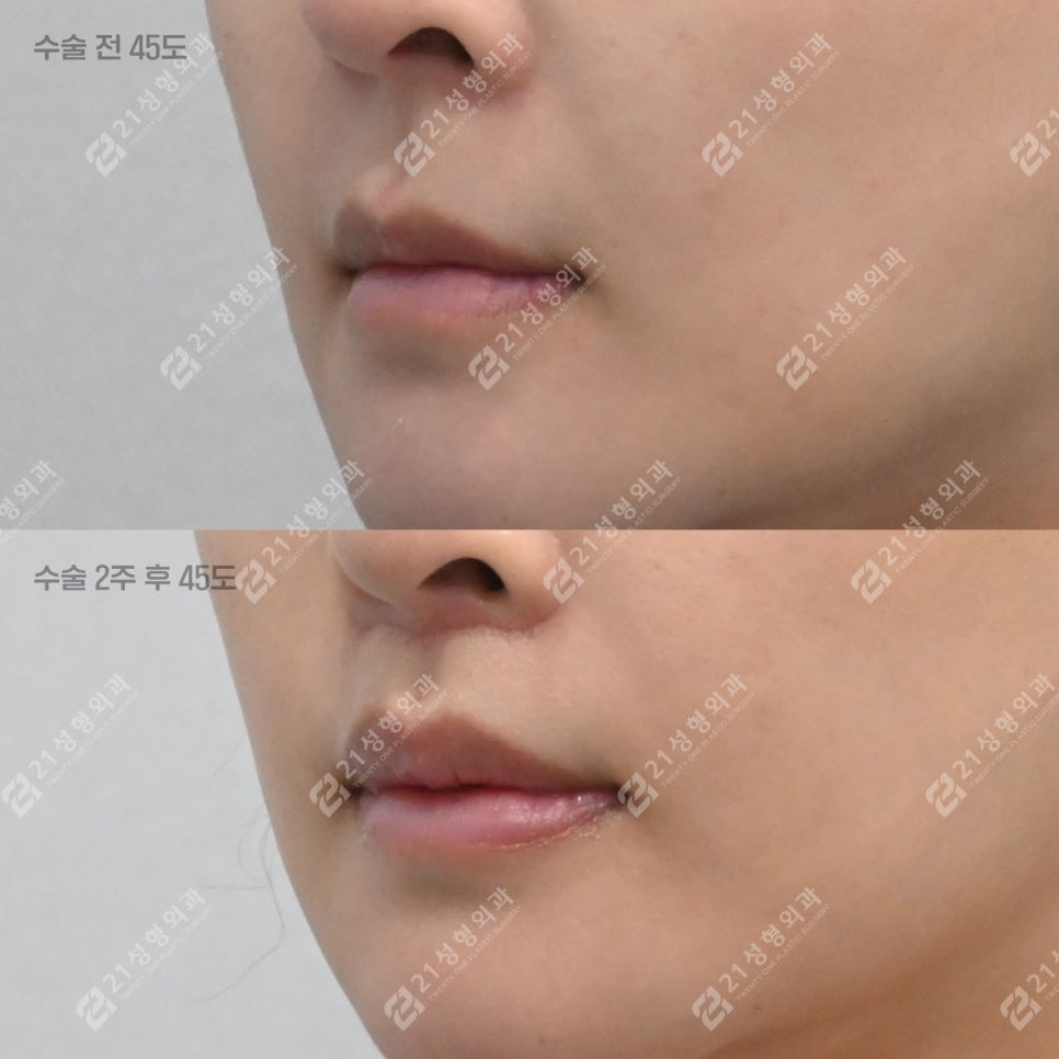 A Lip-Philtrum Reduction Surgery Case: Why Philtrum Dimple Surgery Was Performed Together image 6