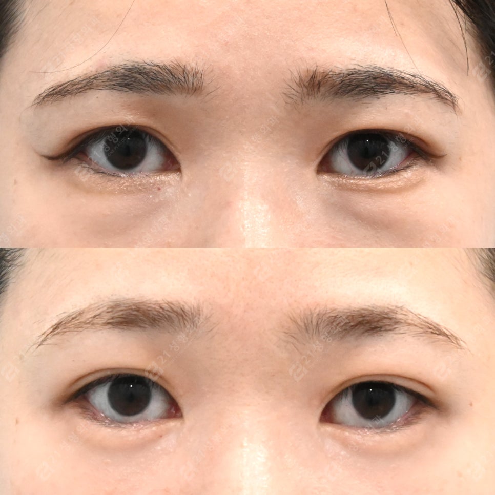 Under-eye fat that filler couldn’t hide: a 3-month and 4-month review after under-eye surgery image 1