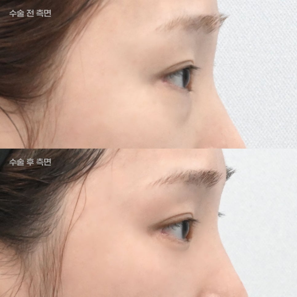 Dark Circles, Caused by Lack of Sleep? Lower Eyelid Fat May Be the Reason! image 5