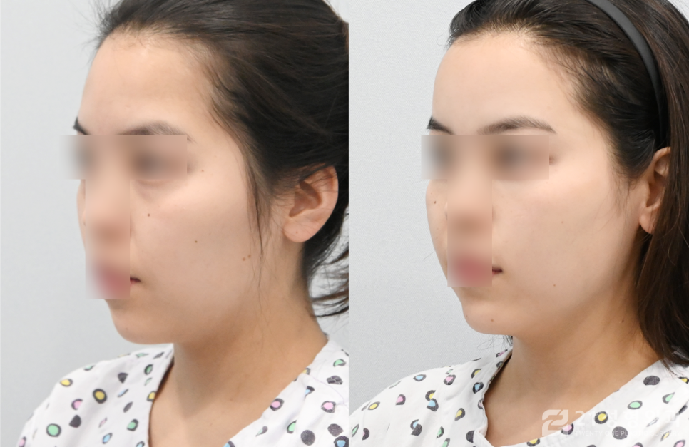 얼굴지방이식잘하는곳 실패 없이 찾는 방법 관련 이미지 2