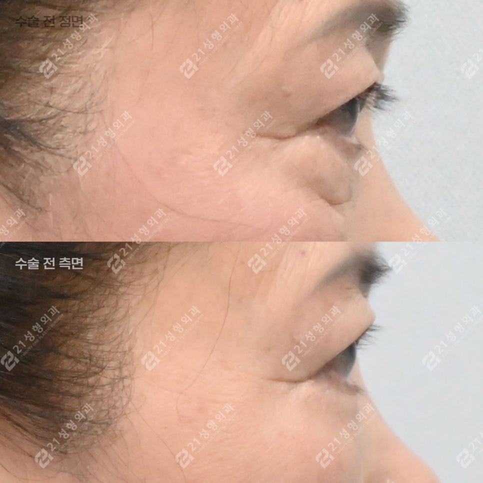 이거 모르면 하안검 수술 절대 하지 마세요! 관련 이미지 5