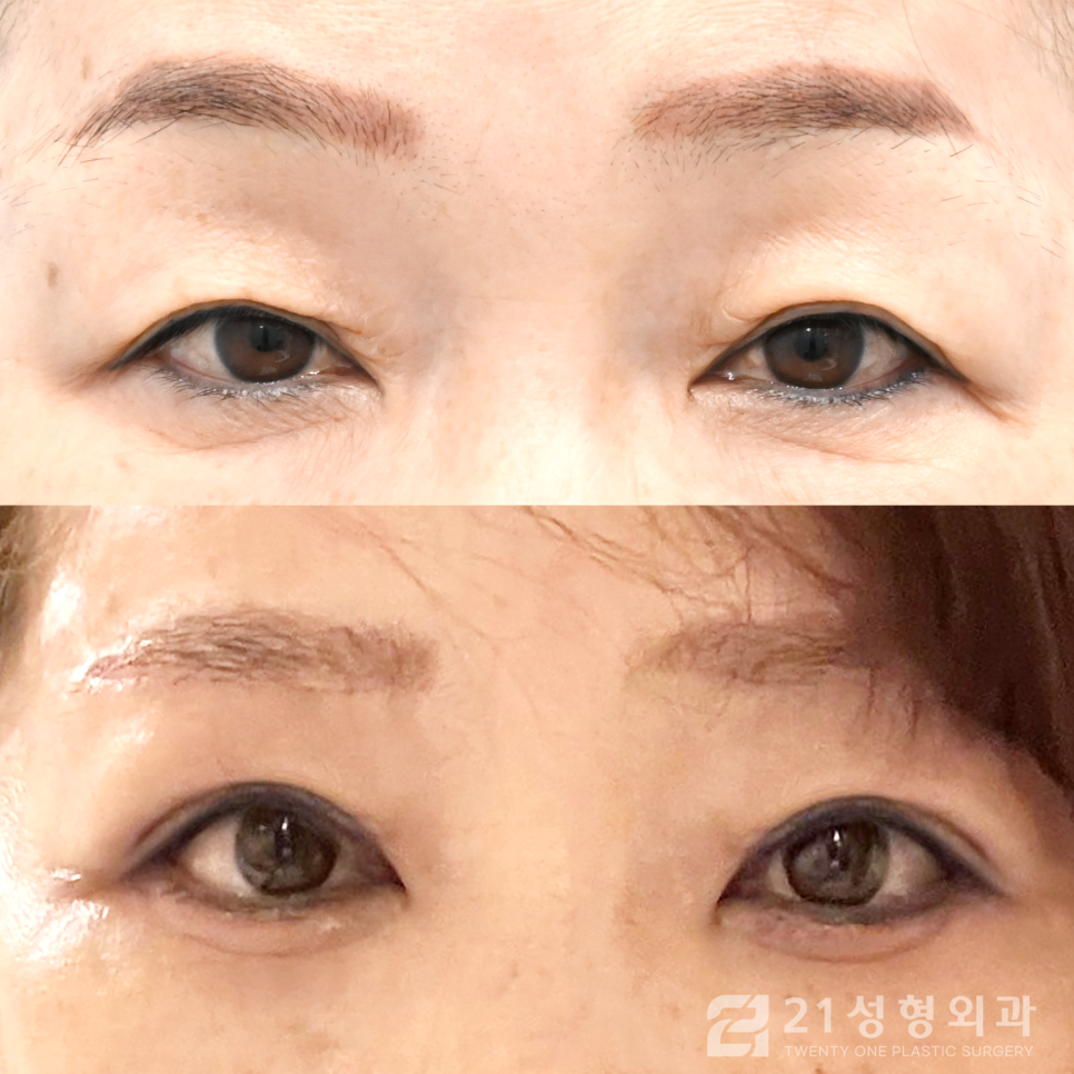 강남눈수술잘하는곳 찾아보고 있다면 관련 이미지 1
