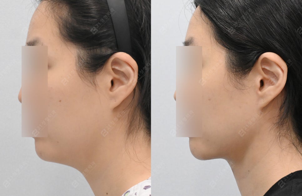 Is simple liposuction enough for double chin surgery? image 2