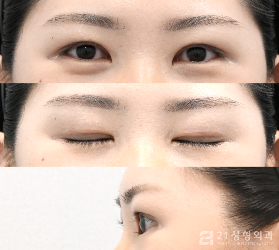 부분절개쌍꺼풀 아름다운 눈매를 위해 관련 이미지 4
