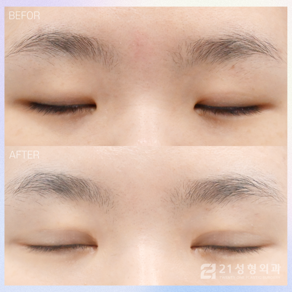 강남성형외과쌍꺼풀을 고민 중이라면 관련 이미지 2