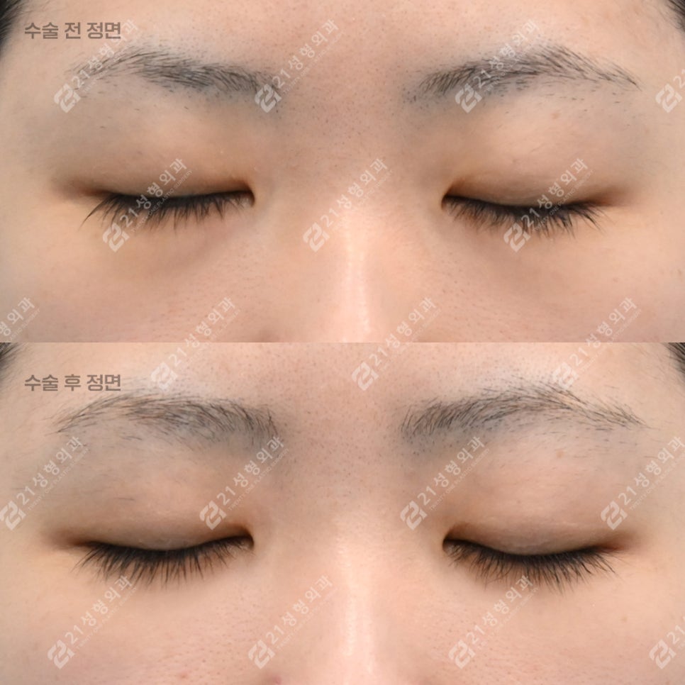 Will Under-Eye Fat Repositioning Improve the Appearance of a Tired-Looking Face? image 4