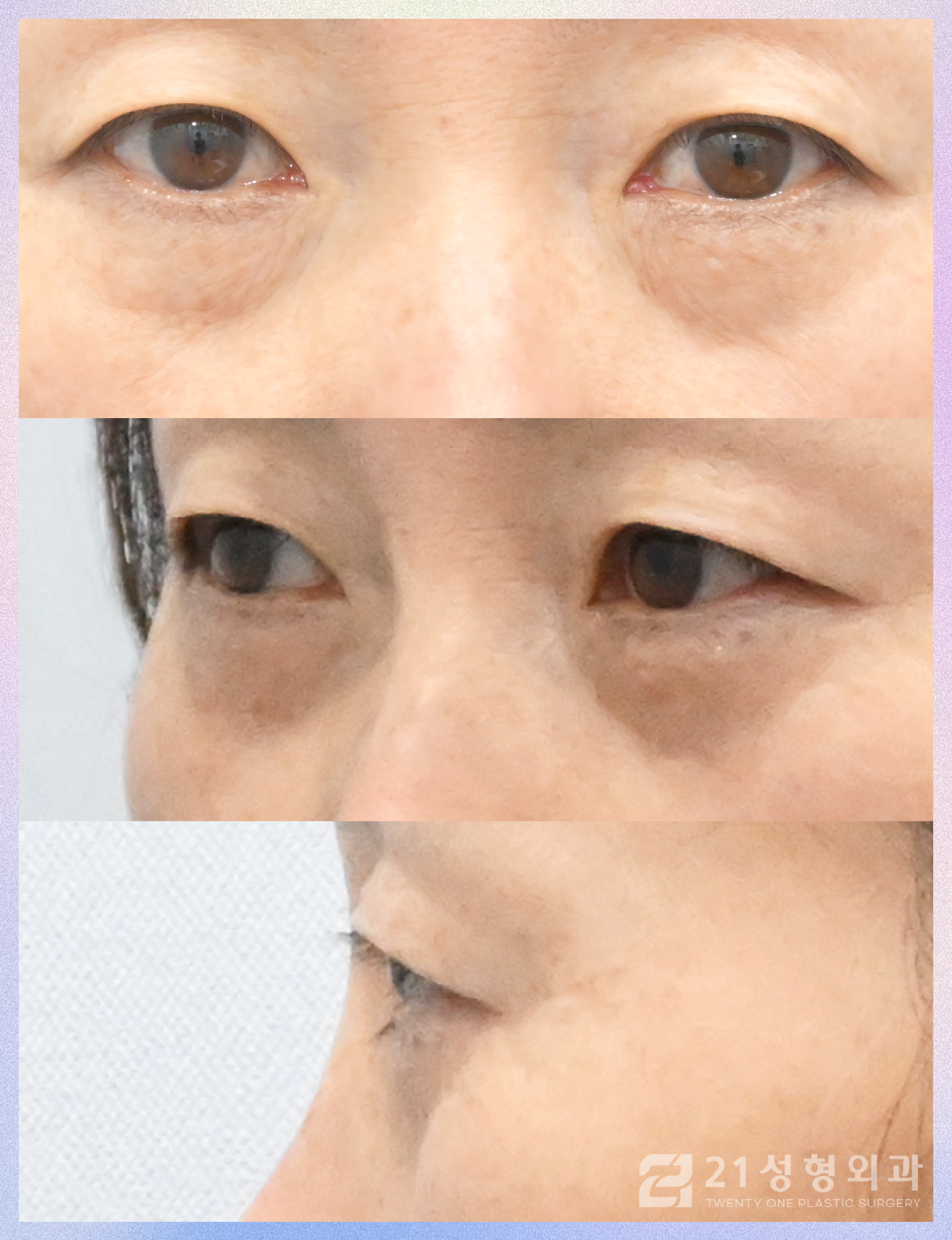 하안검수술후케어 젊음을 유지하기 위해서는 관련 이미지 4