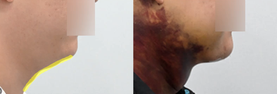 이중턱 수술 후 딱딱함&middot;울퉁불퉁 피부, 괜찮은걸까? 관련 이미지 6