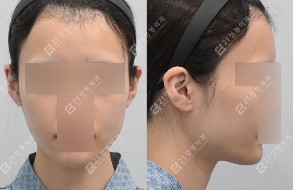 얼굴살이 적으면 윤곽수술 효과가 더 좋을까요? 관련 이미지 4