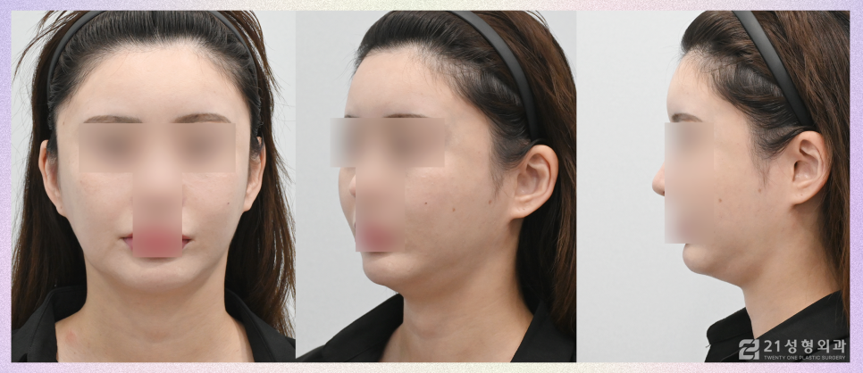 이중턱재수술은 근육묶기로 완성하자 관련 이미지 5