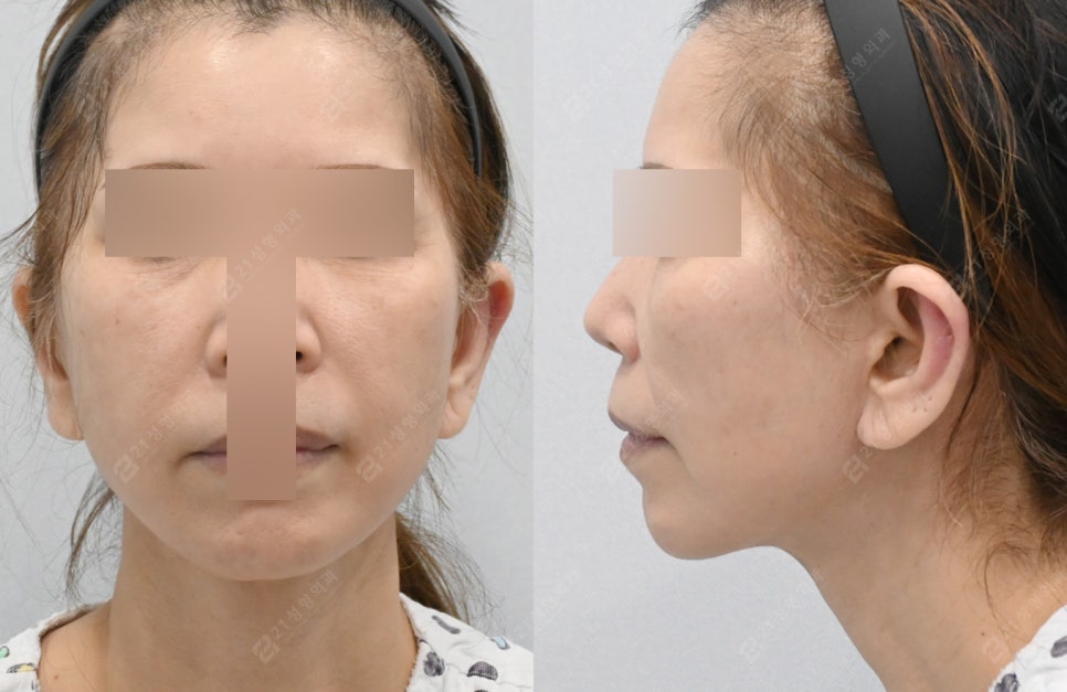 Facelift Surgery Without a Pulled Earlobe: A Real Patient Review image 6