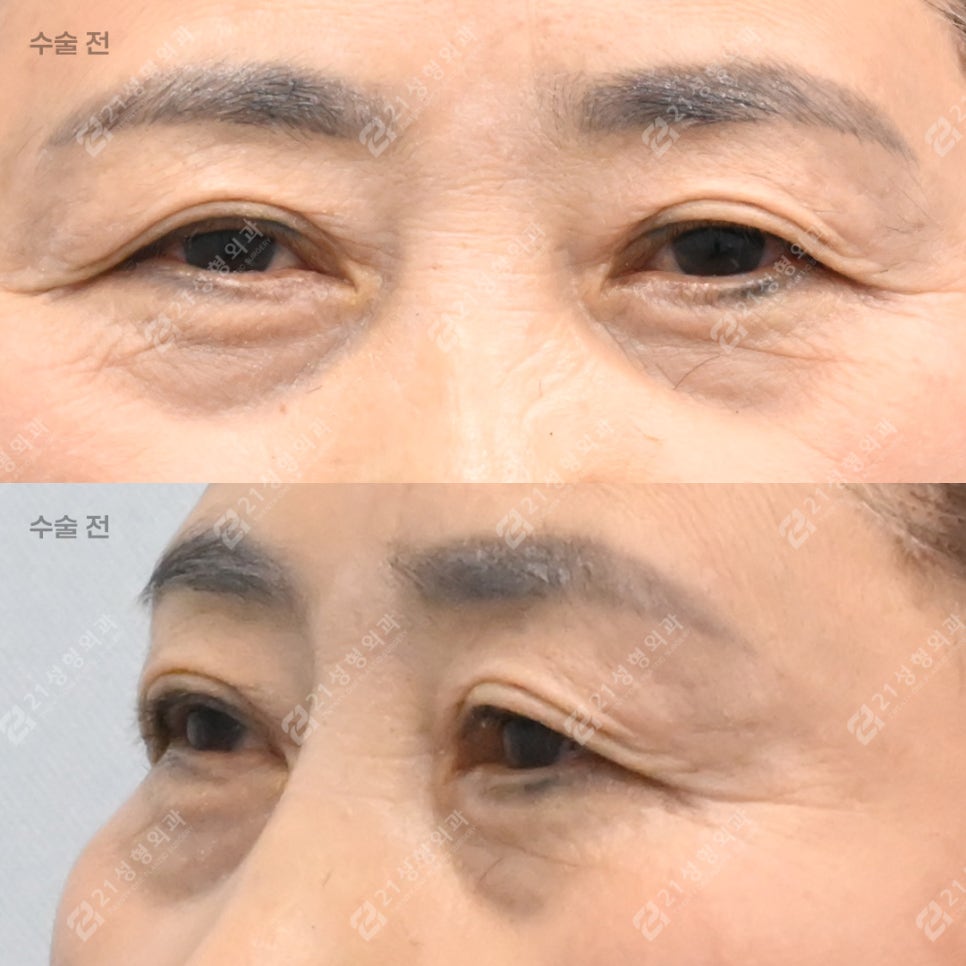 If You Keep Tensing Your Forehead, Consider Eyelid Drooping image 4