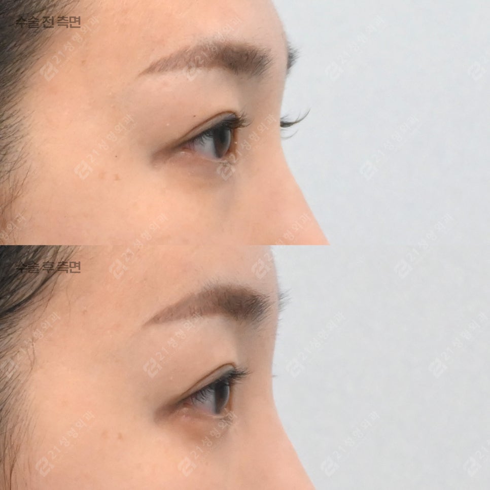 눈밑지방재배치 후 부기 오래가는 이유 관련 이미지 2