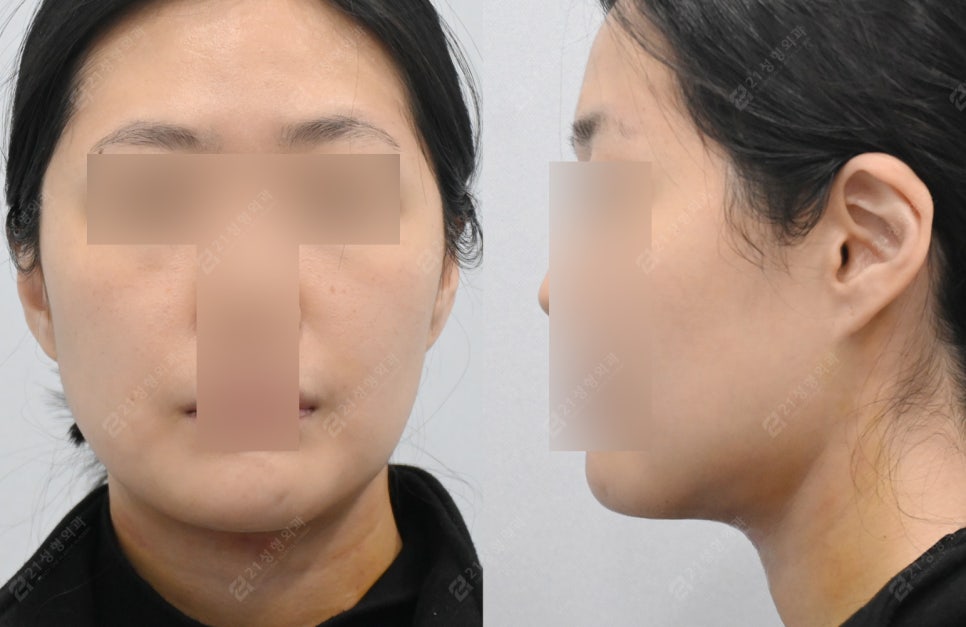 Is simple liposuction enough for double chin surgery? image 4