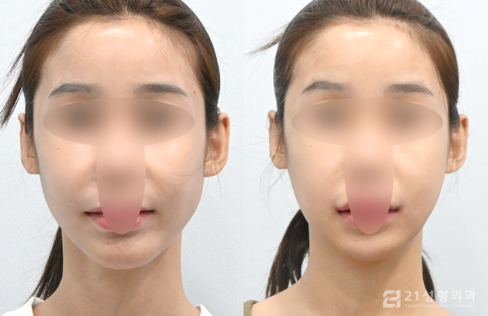 사각턱수술잘하는곳 정보를 알고 싶다면 관련 이미지 1