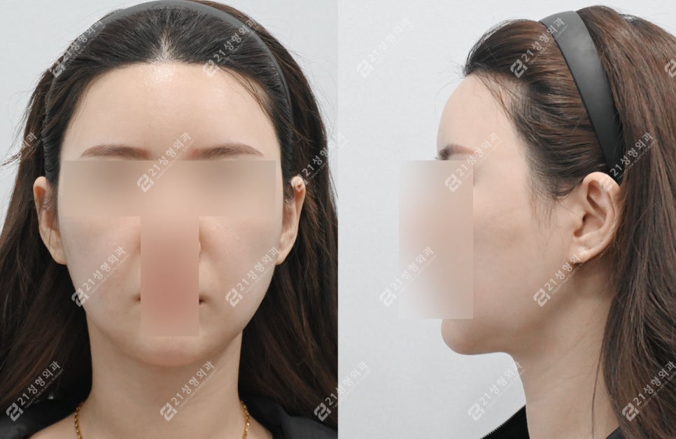 이중턱 수술 후 딱딱함&middot;울퉁불퉁 피부, 괜찮은걸까? 관련 이미지 5