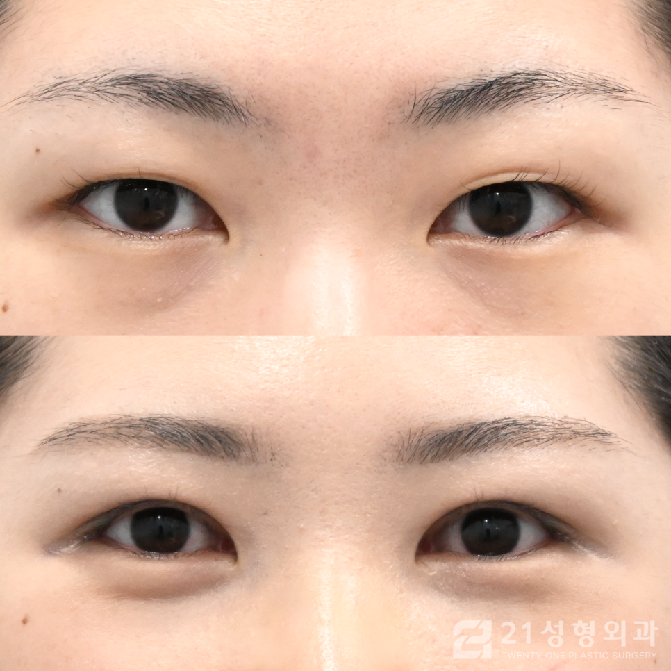 눈매교정병원 자연스러운 눈의 차이 관련 이미지 1