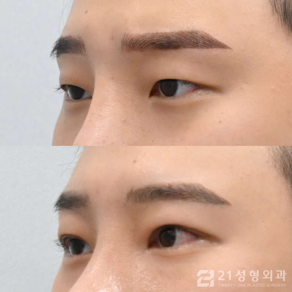 첫눈성형잘하는곳 아름다워지는 지름길 관련 이미지 2