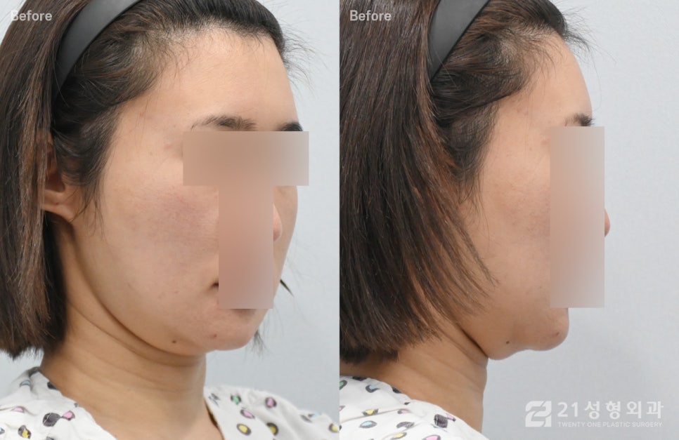 이중턱제거 6개월차 변화과정 후기 관련 이미지 1