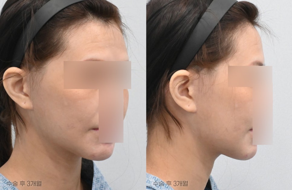 Pixie Ears After a Facelift: Why Do They Differ from Clinic to Clinic? Find Out at 21 Plastic Surgery image 5
