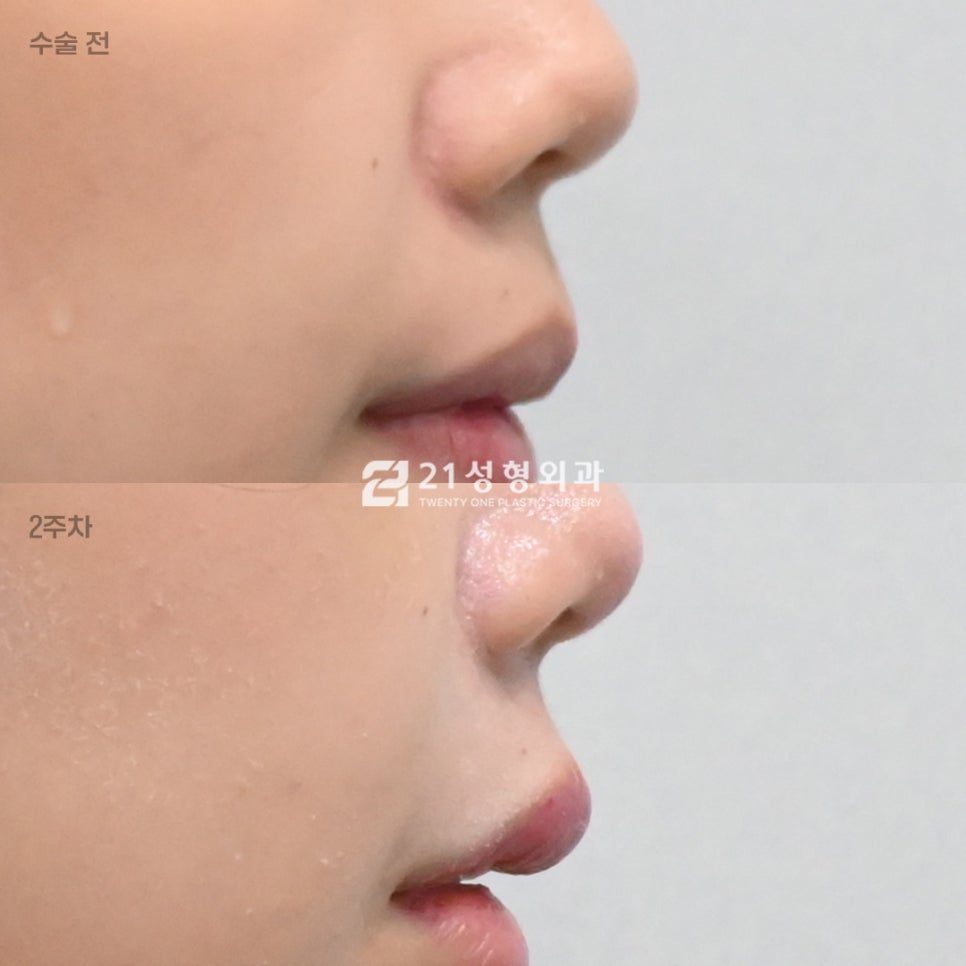 인중 흉터 없이 짧아 보이는 법? 성형외과 원장이 밝히는 인중 라인 착시 효과 관련 이미지 3