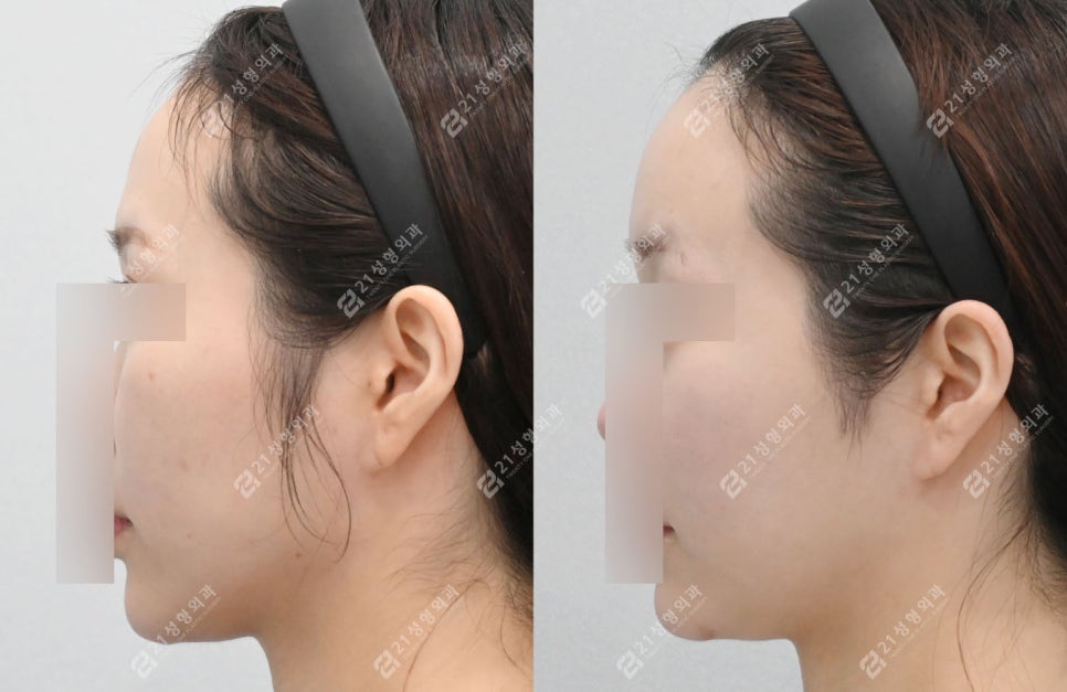 광대축소로 얼굴 인상이 달라진 케이스, 분위기가 이렇게 달라집니다 관련 이미지 6