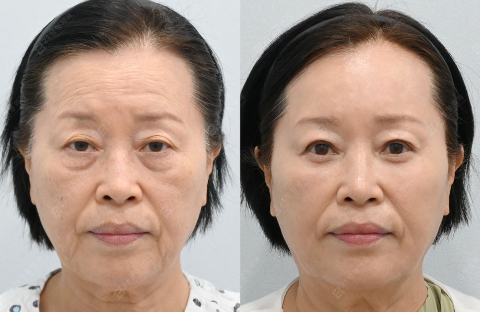 자연스럽게 젊어지고 싶다면? 중년 수술 이마거상, 상.하안검으로 해결! 관련 이미지 1