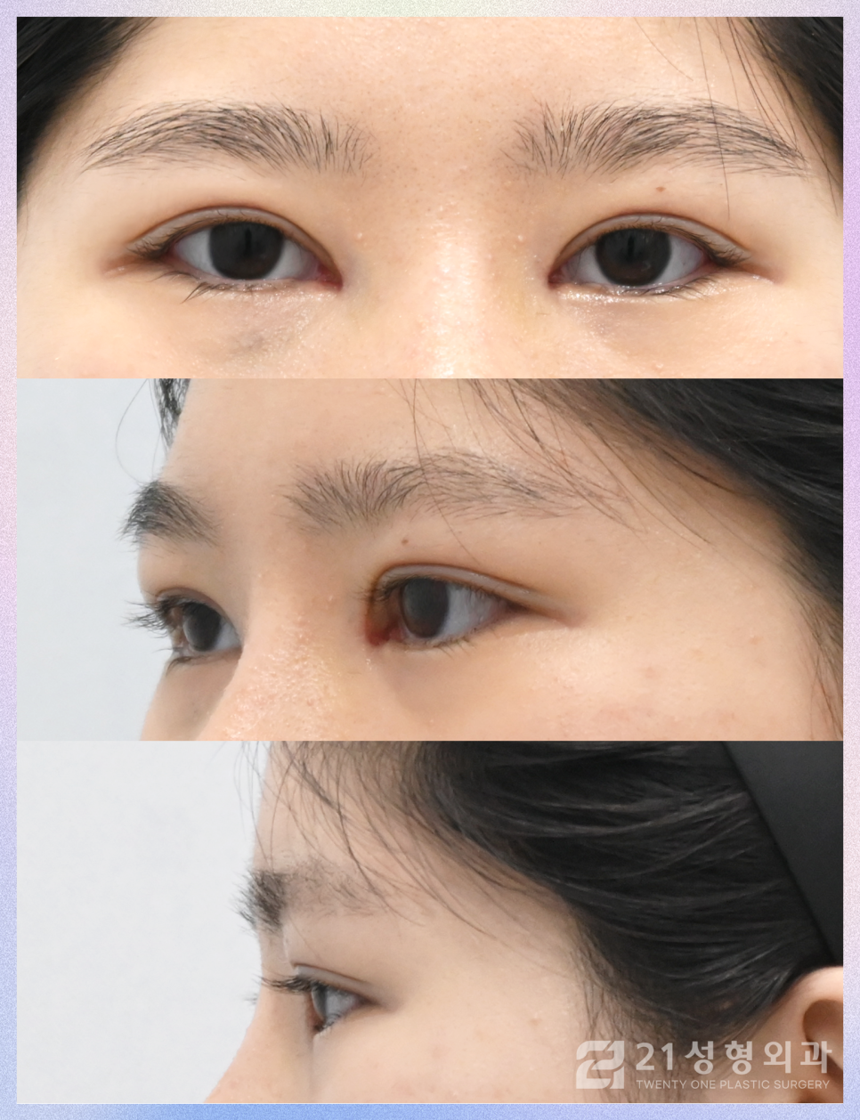 강남눈성형잘하는곳 차이점은 관련 이미지 7