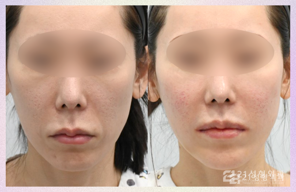 강남인중성형만으로 중안부 줄이기 관련 이미지 1