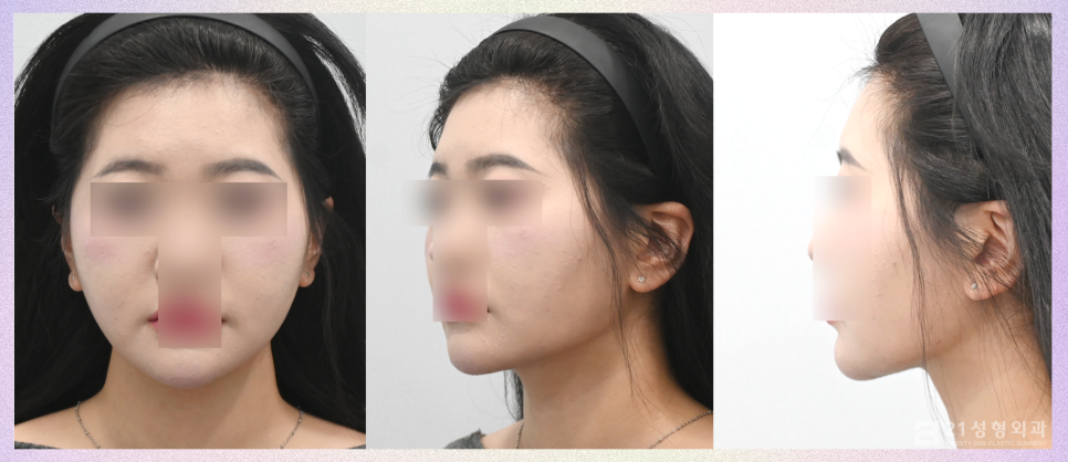 투턱지방흡입 갸름한 턱라인을 위해 관련 이미지 7