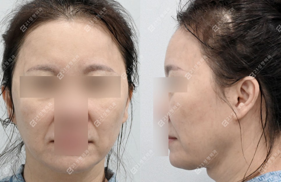 A Face That Needed a Lift, Not a Thread Lift — and There Was a Reason image 1