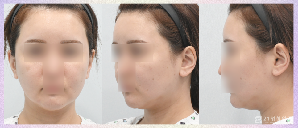 동안리프팅 맞춤 안면거상과 목거상 관련 이미지 4