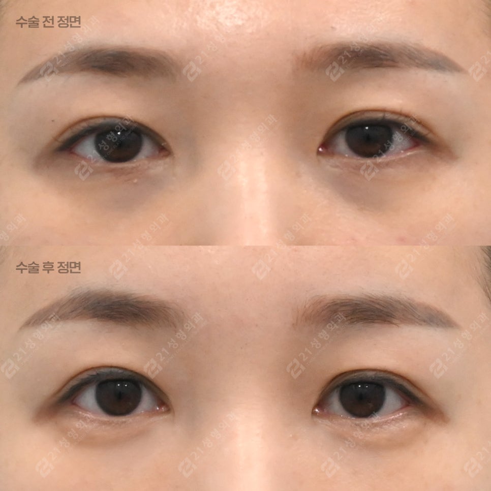 눈밑지방재배치 후 부기 오래가는 이유 관련 이미지 1