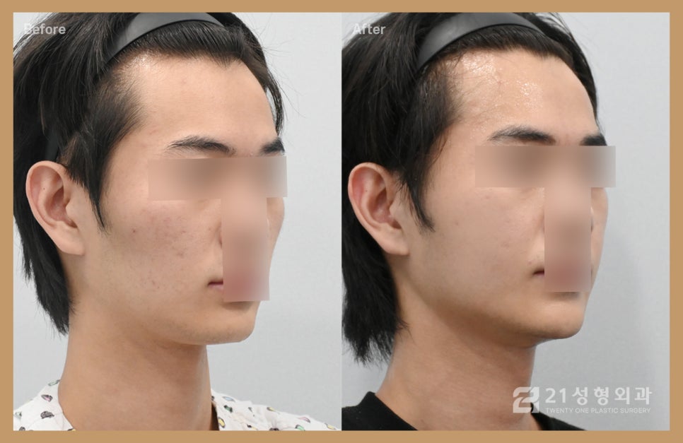 옆광대수술 전 필수로 확인해야 하는 것 관련 이미지 2