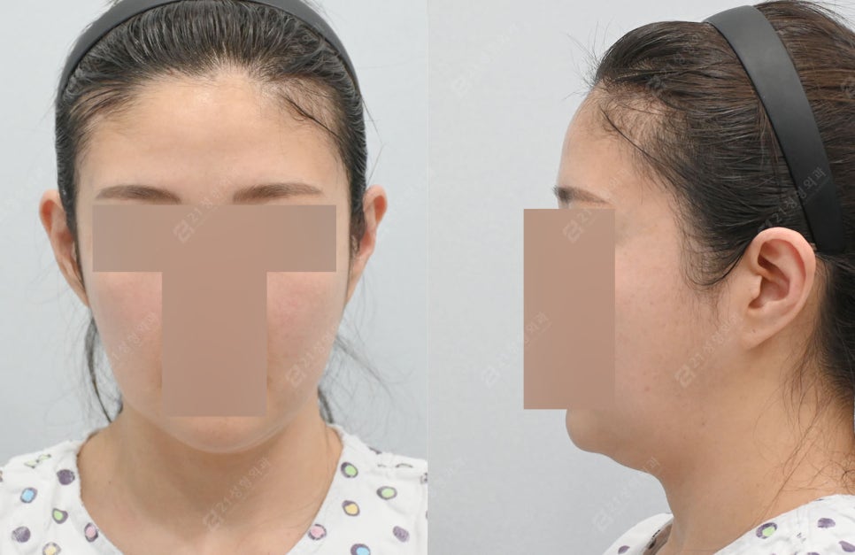Real Review: A Smooth Improvement of Leftover Double Chin and Jowl Fat Even After Dieting image 2