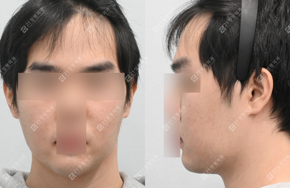 Male Double Chin + Chin Advancement Surgery Real Case: Why the Mood and Impression Change image 6