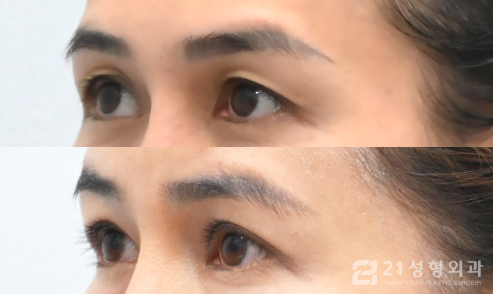 눈매교정잘하는곳 또렷해지고 싶다면 관련 이미지 2