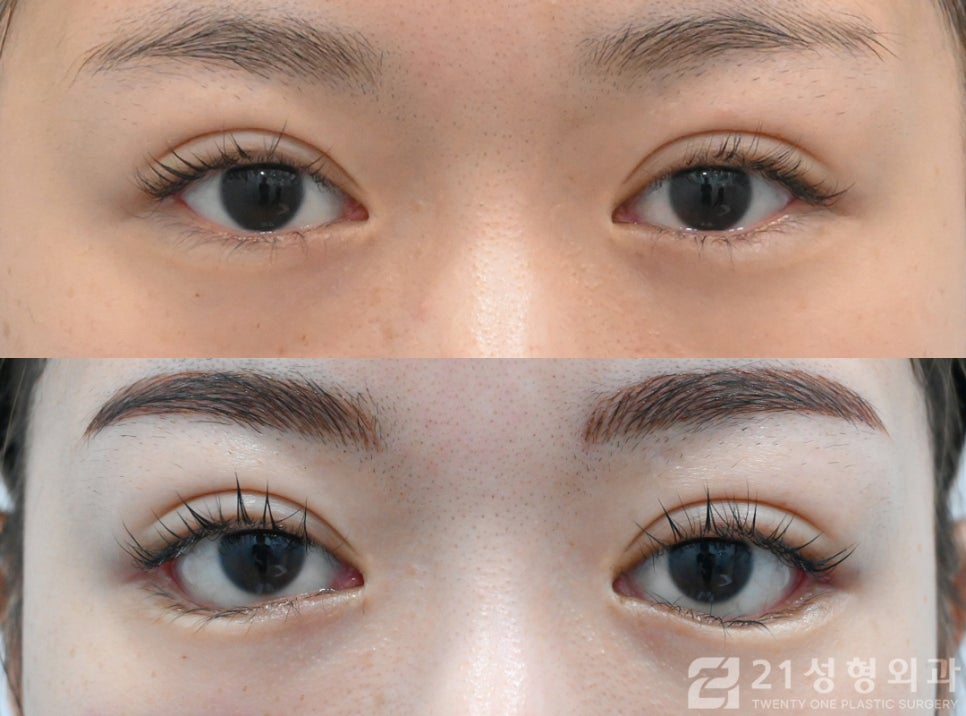 재발하기 않는 밑트임 방법 21성형외과 관련 이미지 1