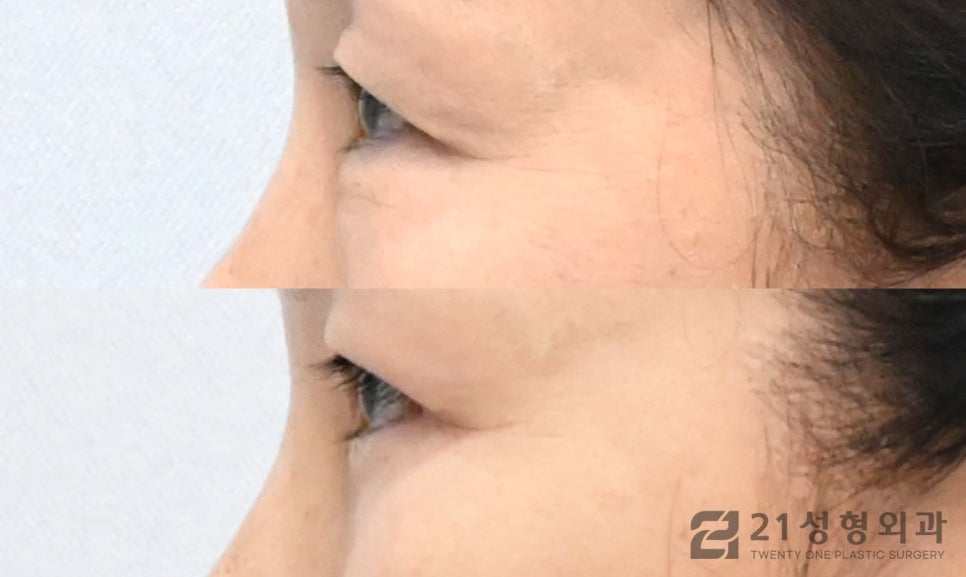 하안검수술잘하는병원 선택 노하우는 관련 이미지 3