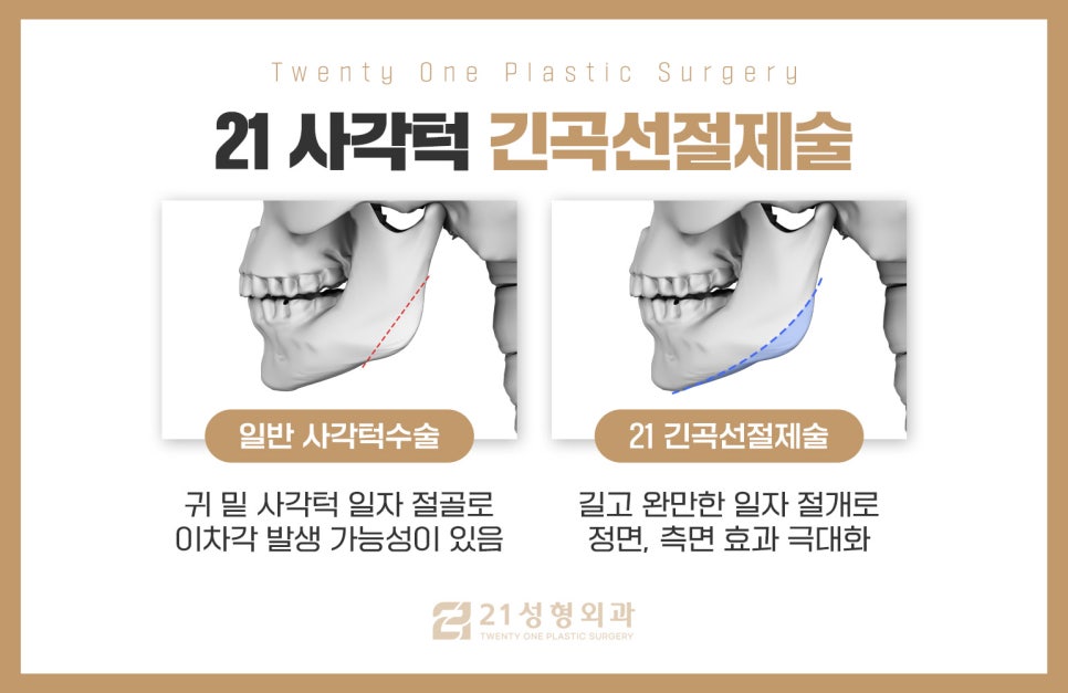 사각턱성형 부작용 없이 이득 보는 비결 관련 이미지 4