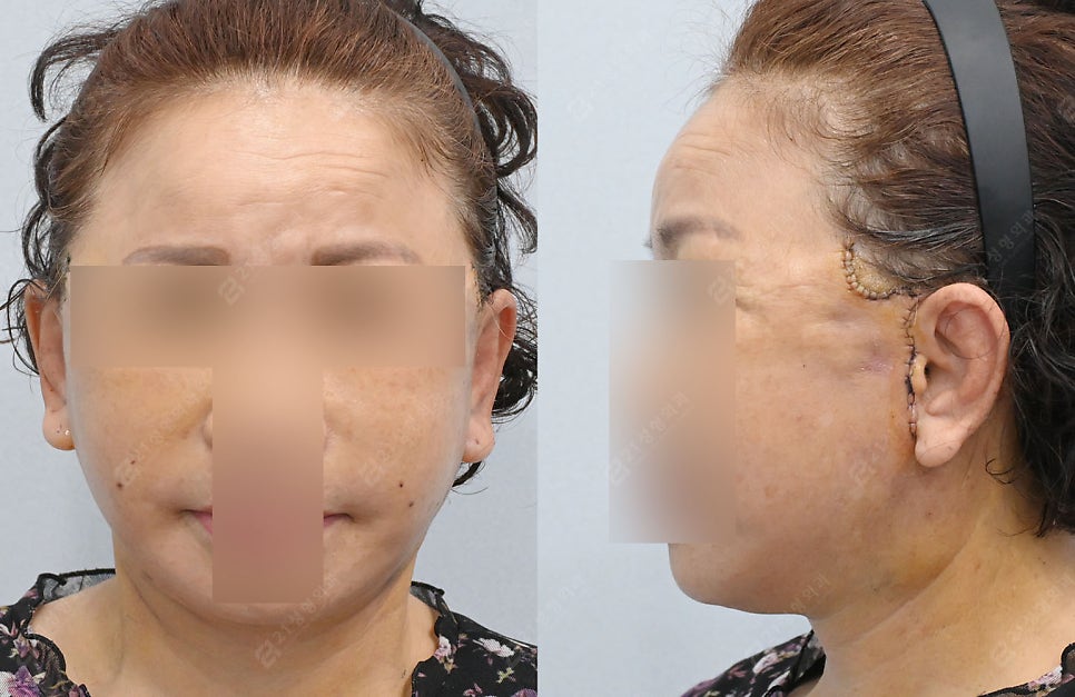 Let’s Address Facial Sagging from the Root Cause! Real Changes from a Face and Neck Lift image 3