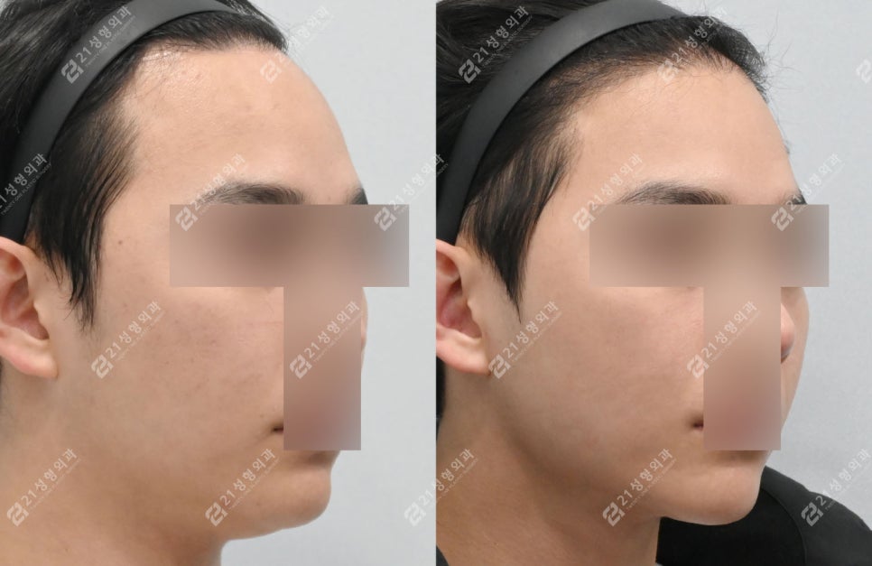 살은 안 쪘는데 왜 이중턱만 남을까? 남자 이중턱의 진짜 원인 관련 이미지 6